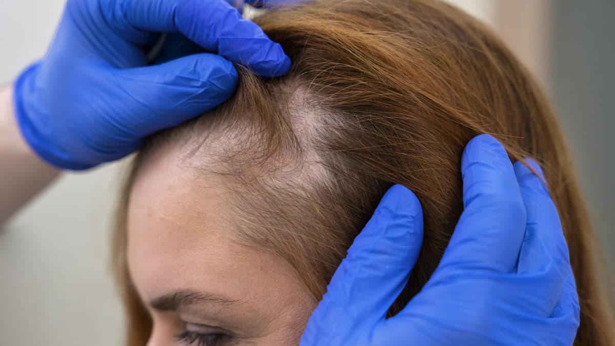 Alopecia exige diagnóstico específico para tratamento eficaz, destaca especialista