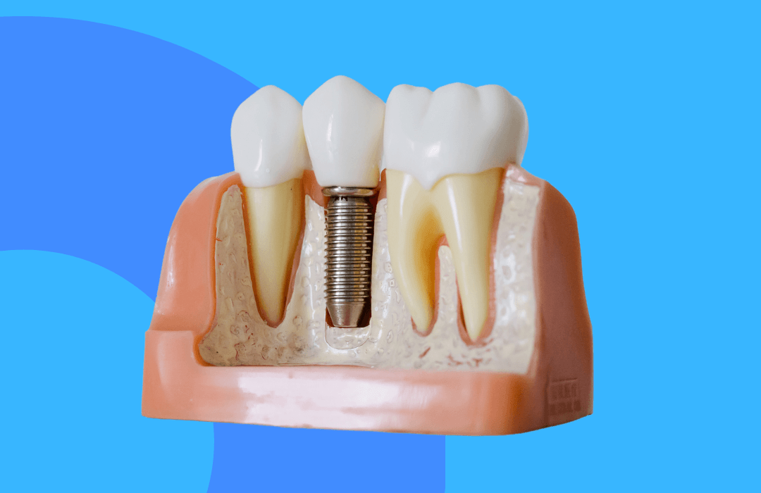 Quanto custa um implante dentário em Imperatriz? Entenda os valores e o que considerar