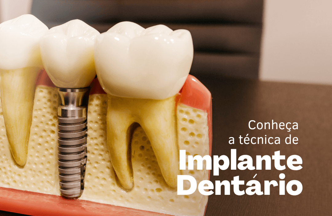 Implantes dentários em Imperatriz: Odonto Leve se destaca entre as clínicas para recuperar o sorriso